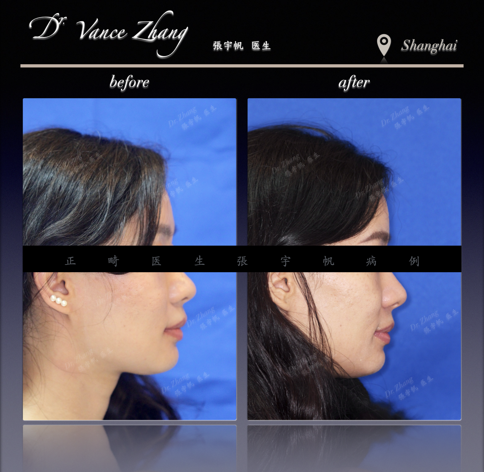 陡峭Spee曲线伴深覆合的隐形矫治正式病例贴图5