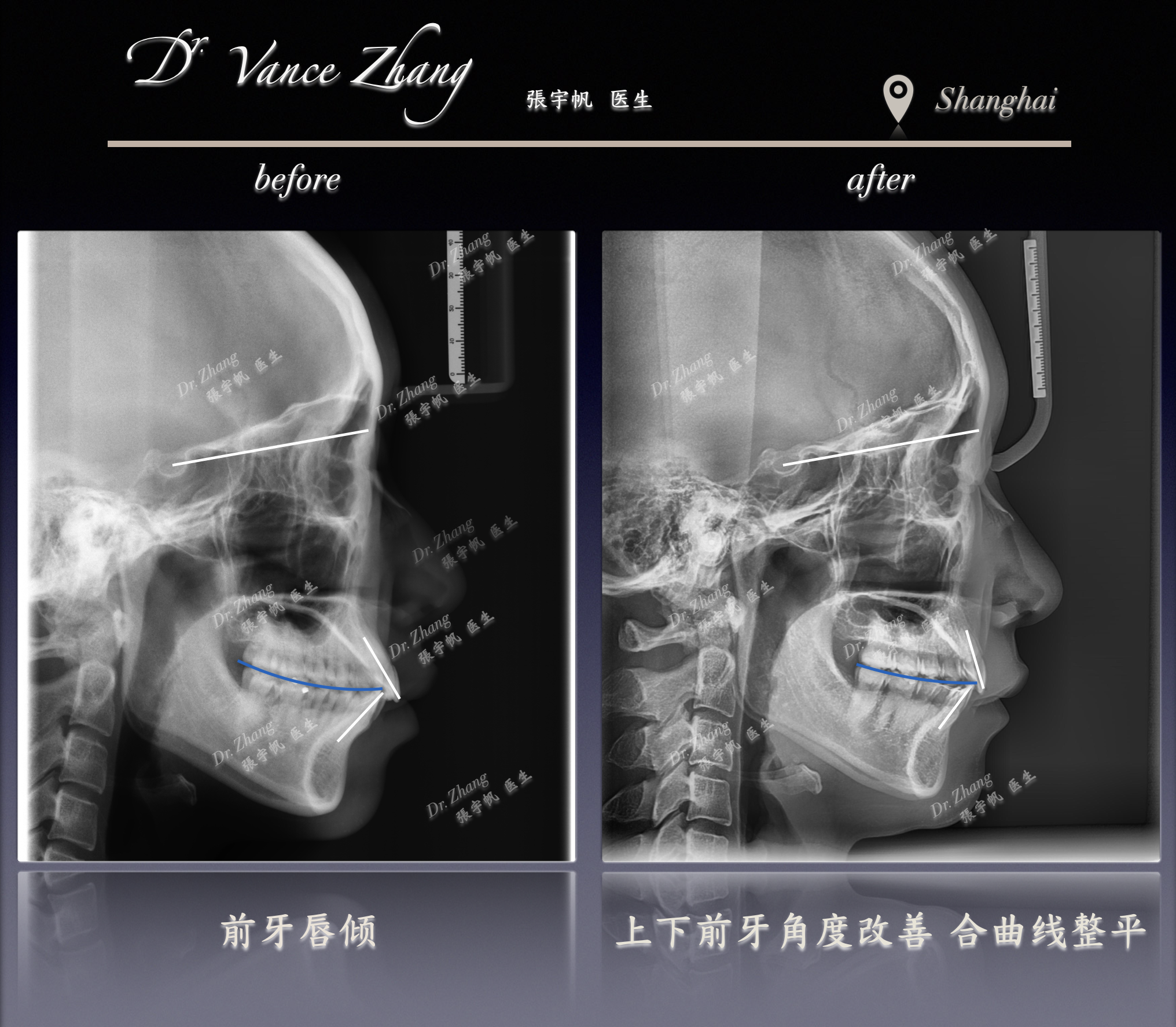 从嘴突到协调侧貌正式病例贴图13