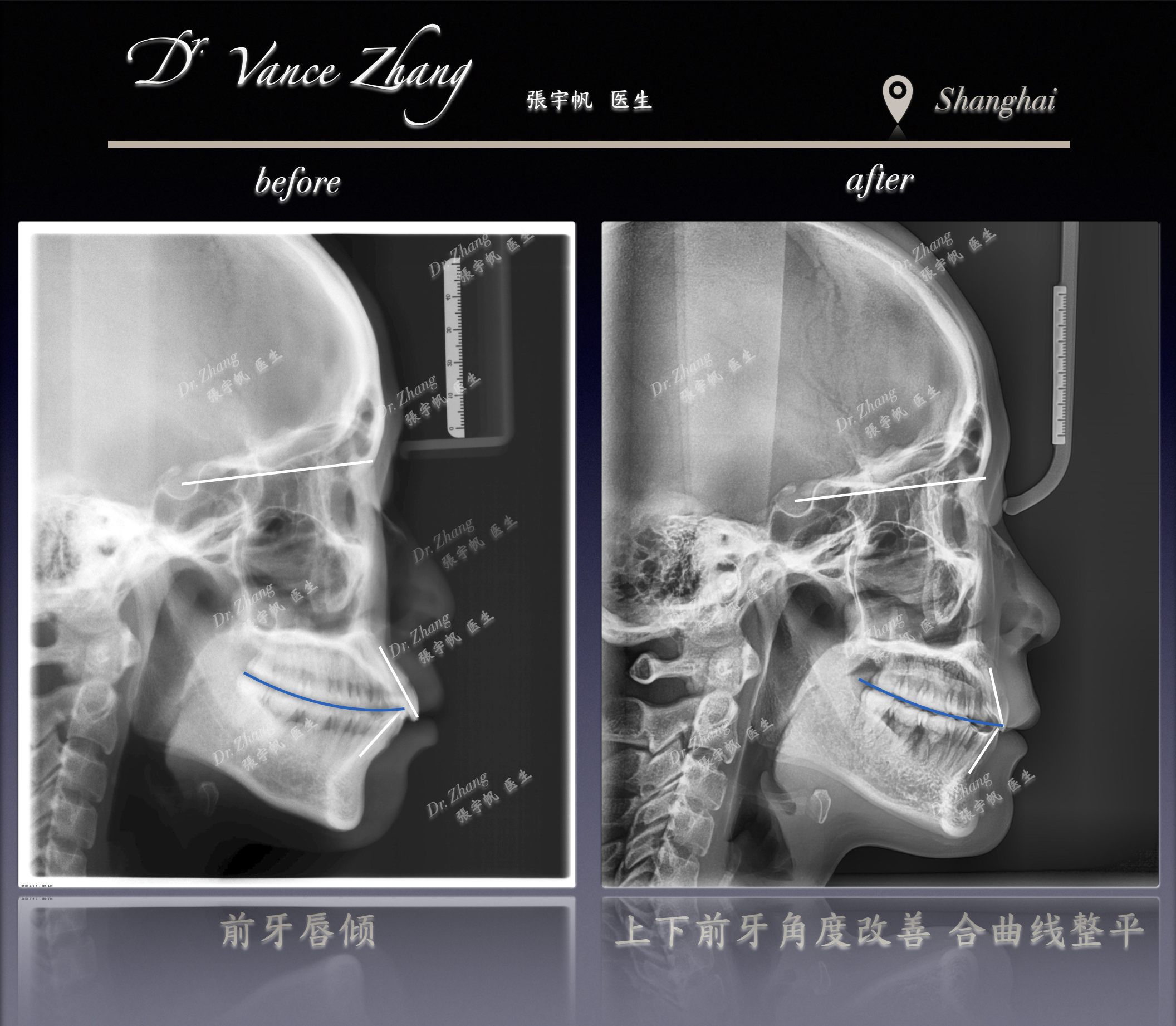 成人女性骨型双颌前突矫正正式病例贴图15