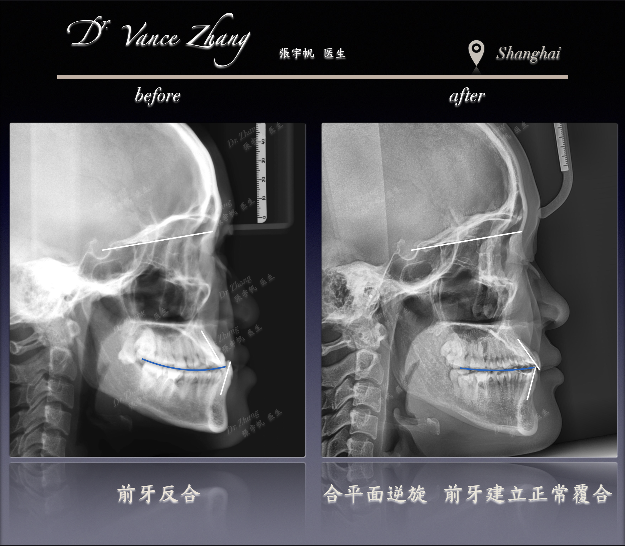 重度骨性III类的非手术改善正式病例贴图15