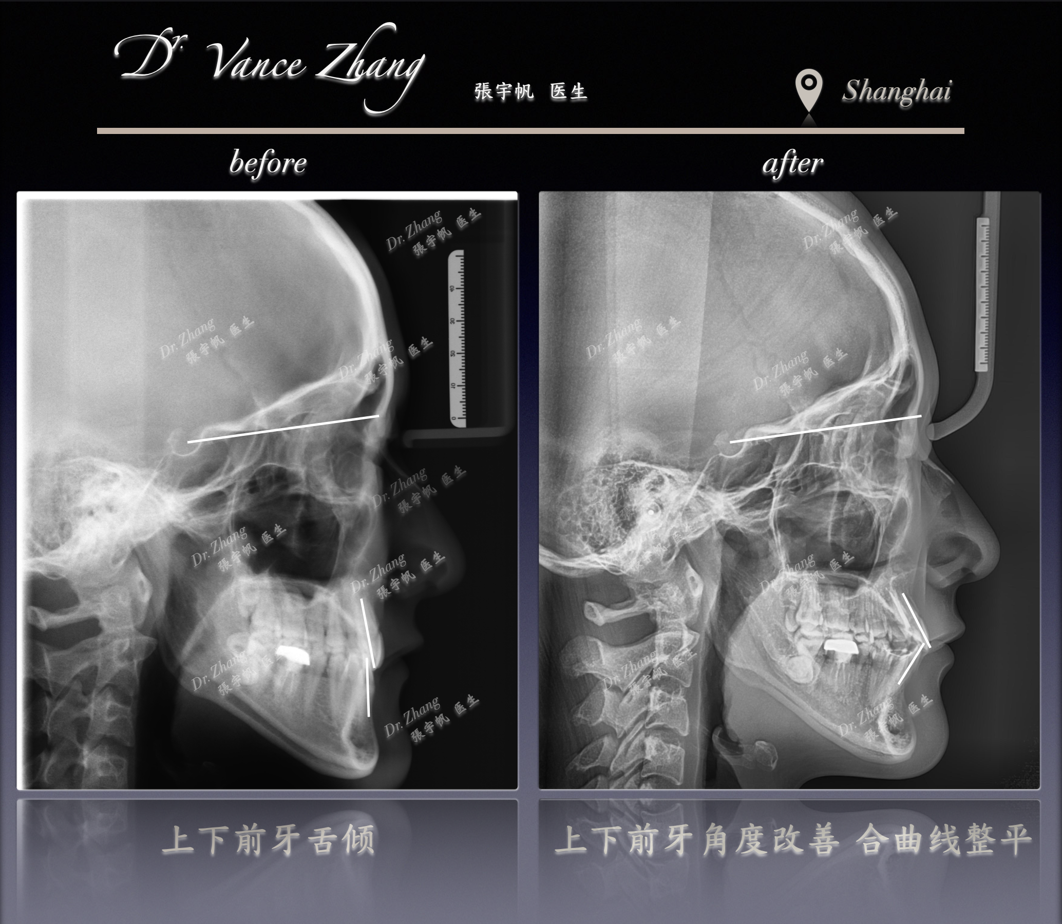 从凹面型到协调侧貌正式病例贴图15