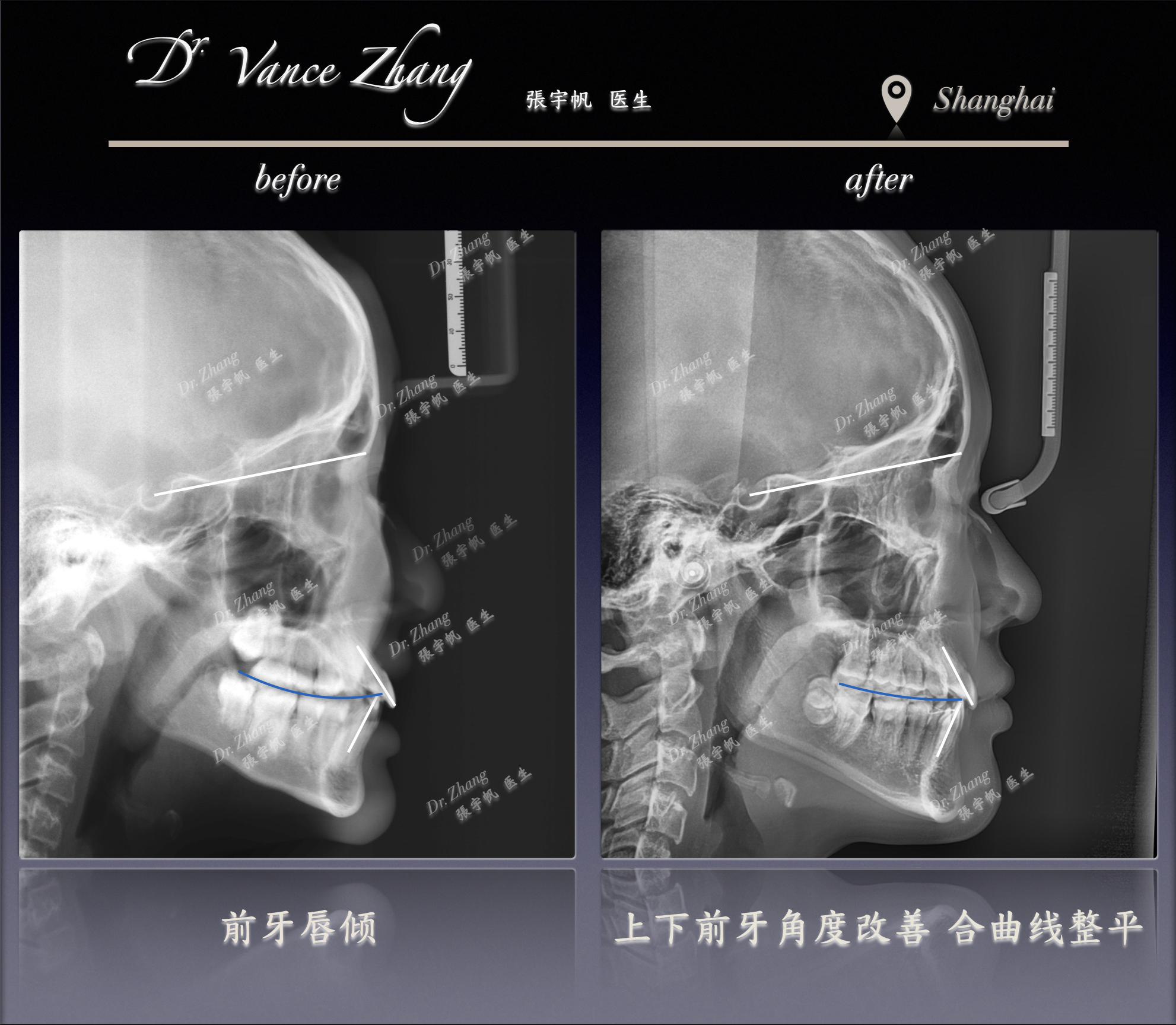 牙列拥挤伴下牙列偏斜正式病例贴图15