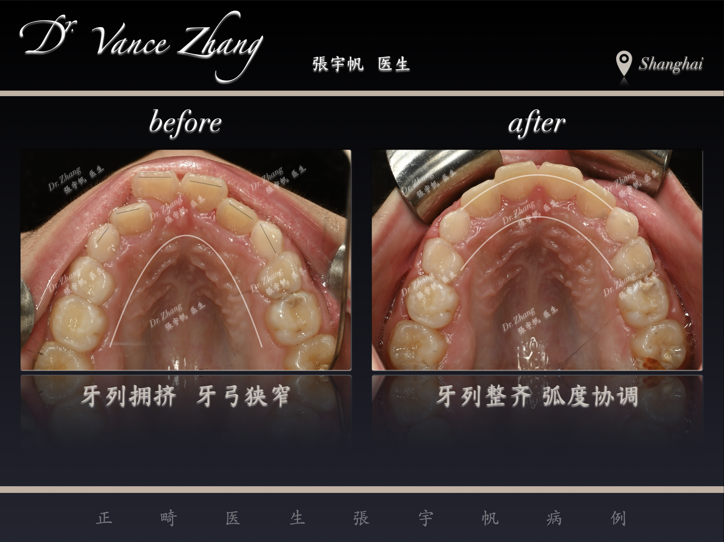 儿童牙弓狭窄的早期矫治正式病例贴图13