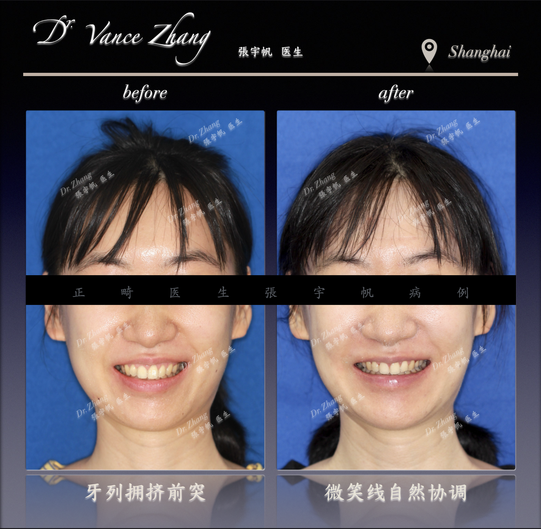 从嘴突到协调侧貌正式病例贴图3