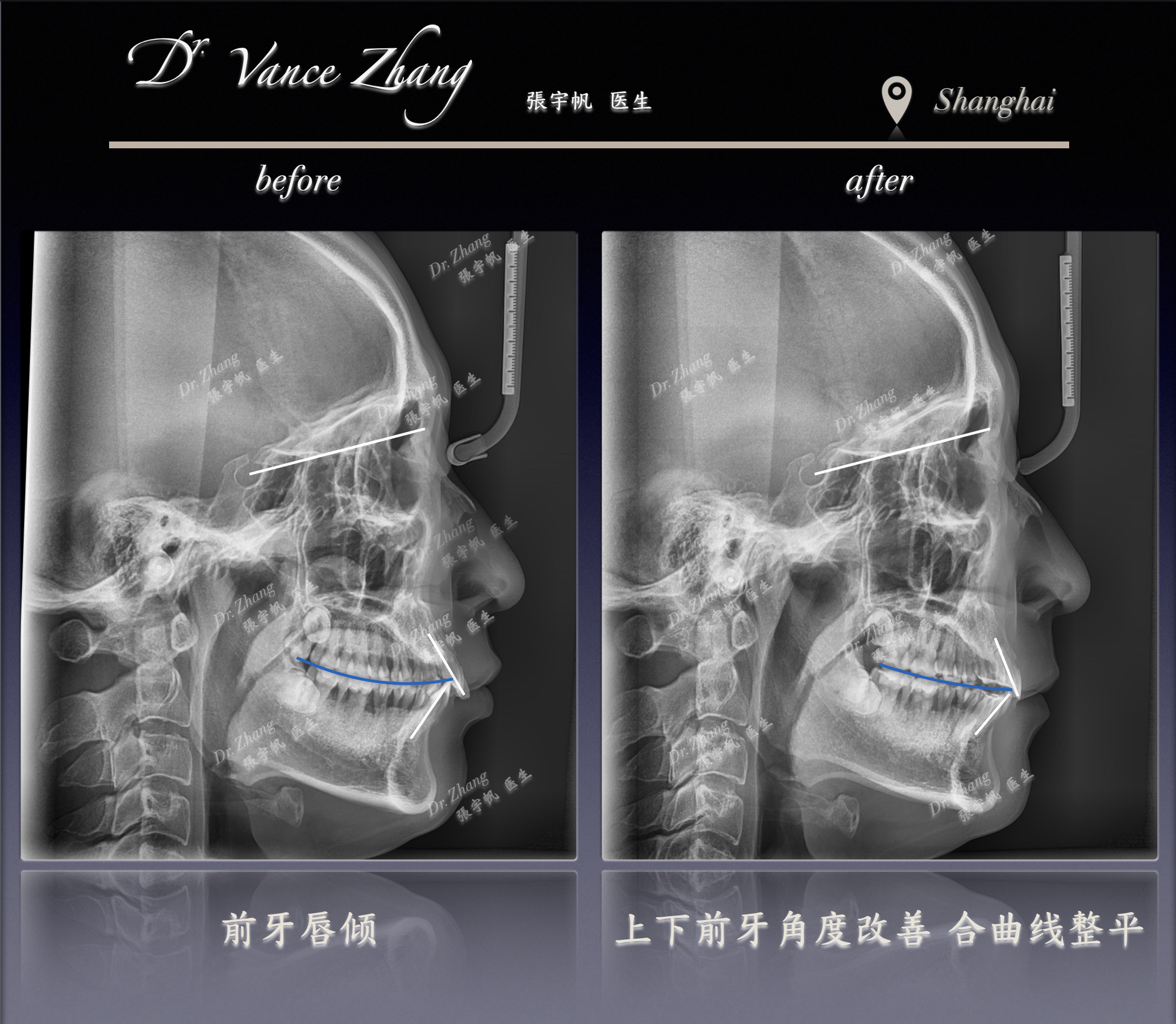 深覆合继发咬合创伤的正畸重建正式病例贴图17