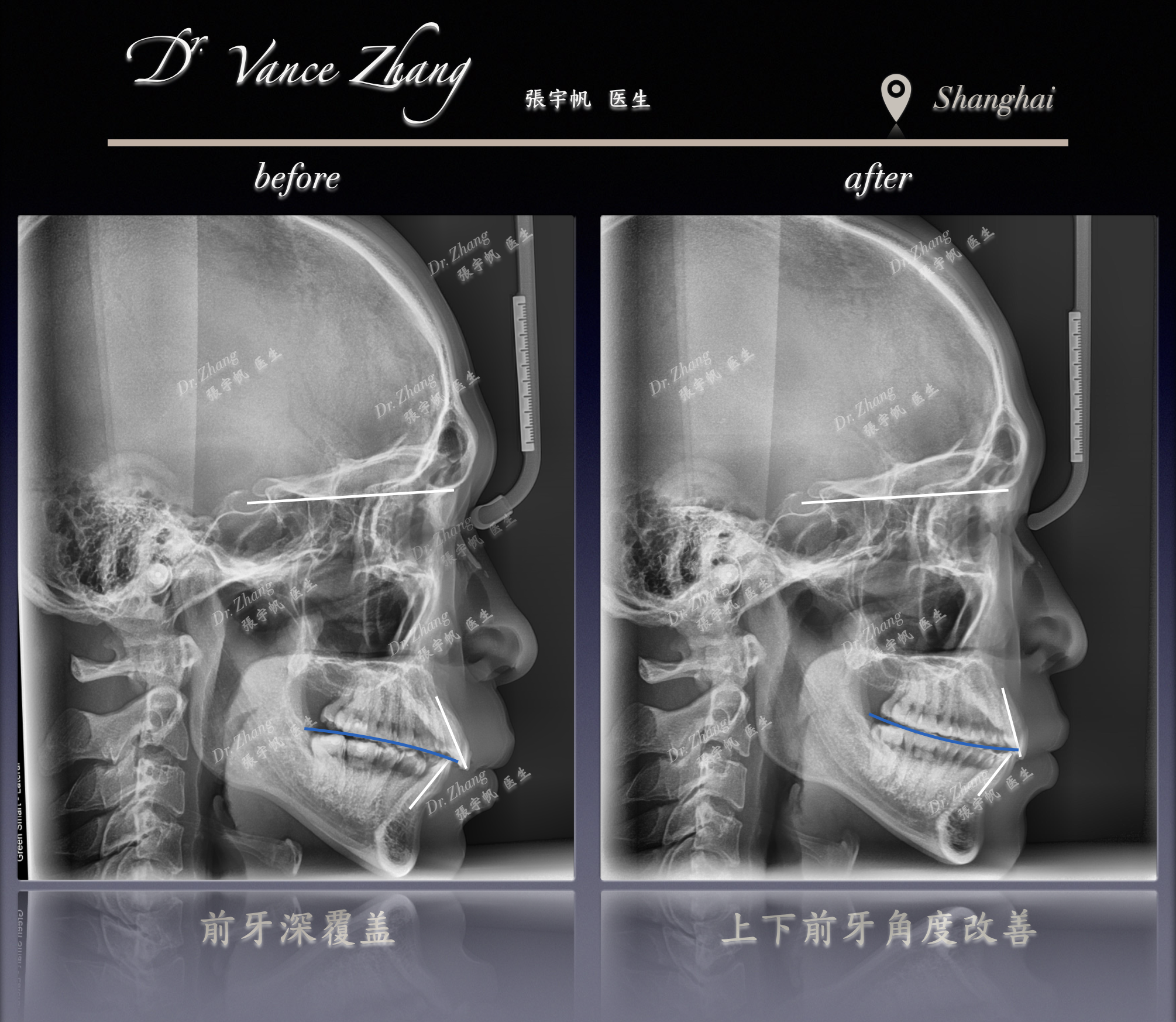 成人Ⅱ类错𬌗的单侧磨牙远移矫治正式病例贴图15