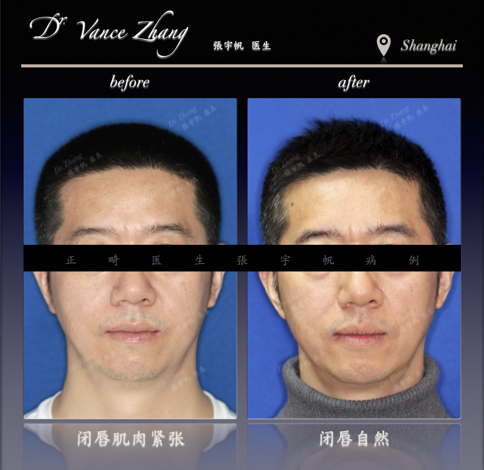 拔除下7后近移智齿替代正式病例贴图2