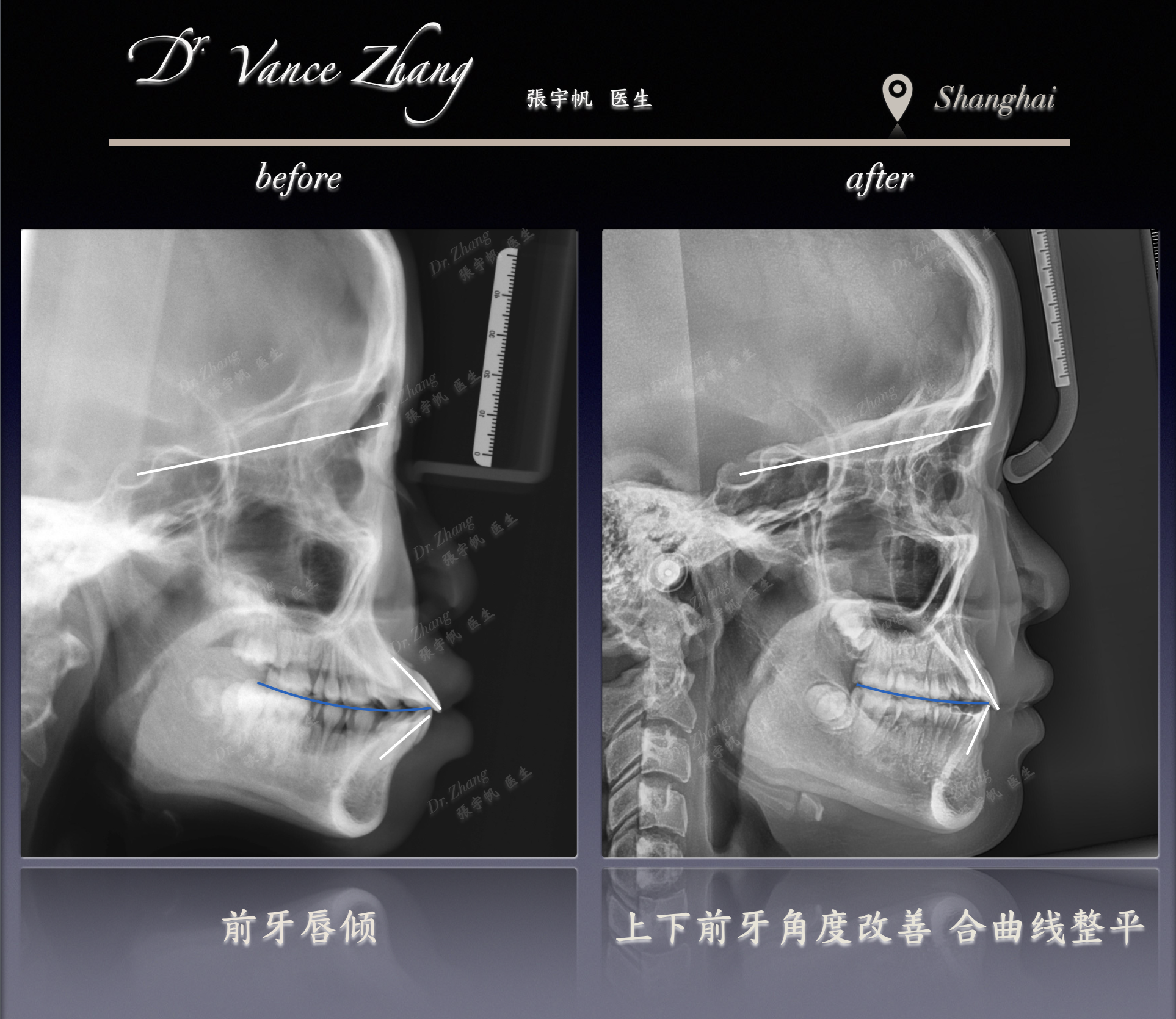 青少年嘴突改善正式病例贴图15