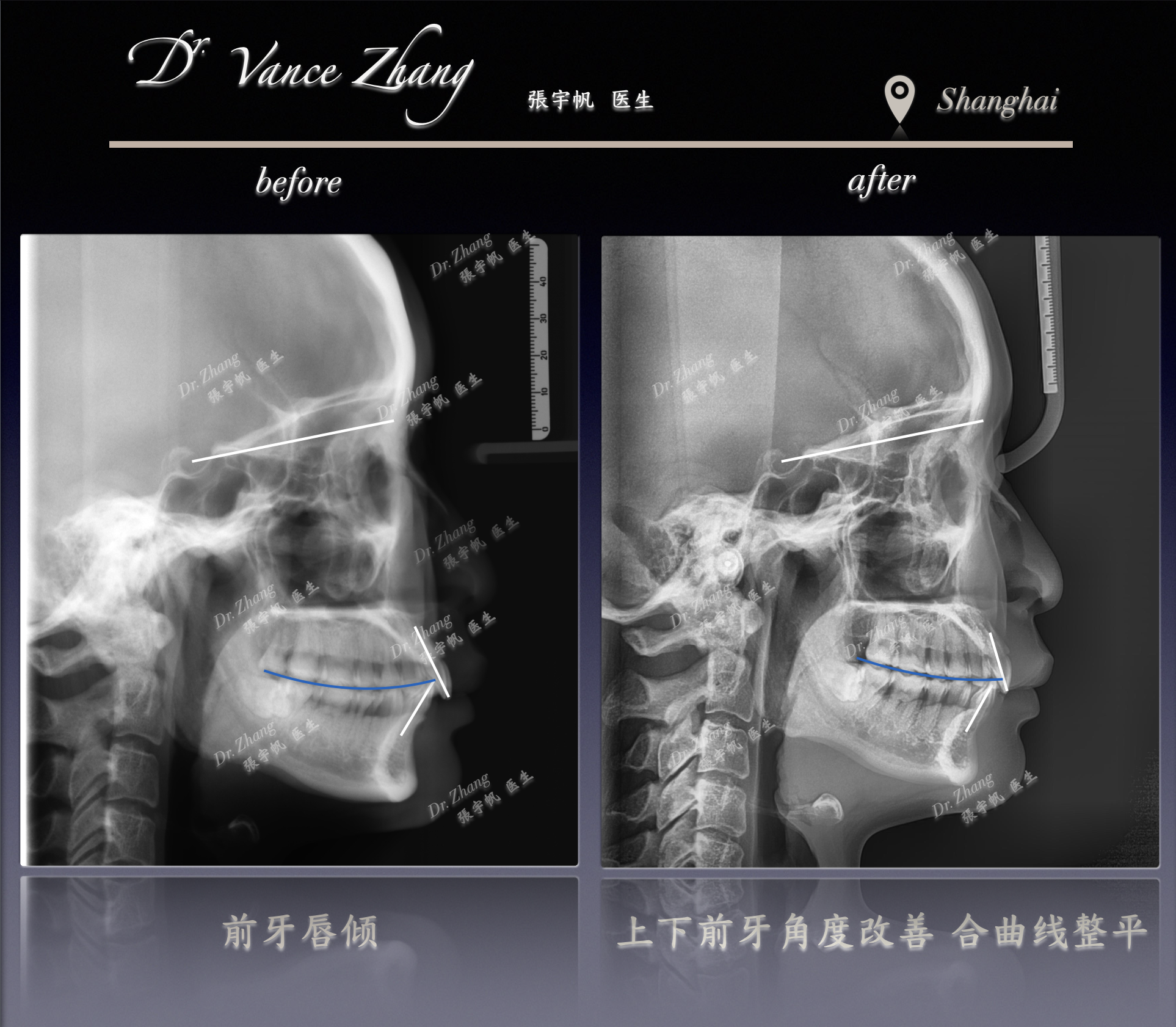 隐形矫正单侧推磨牙向后正式病例贴图14