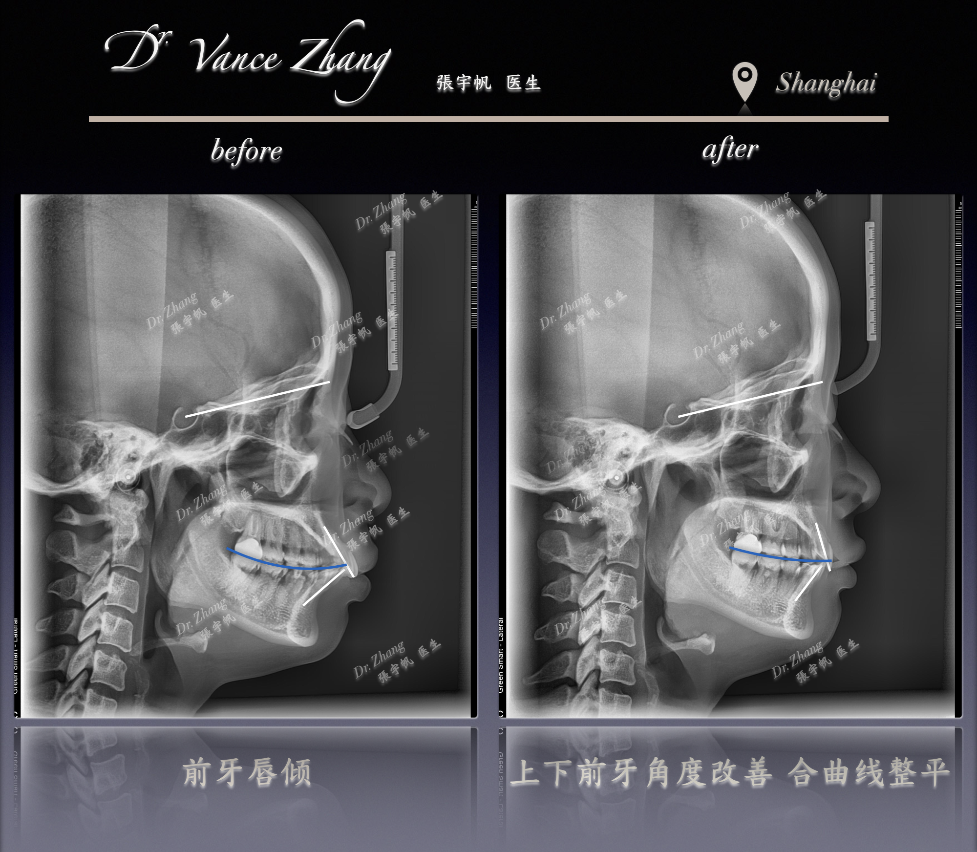 从拥挤前突到自然微笑正式病例贴图15