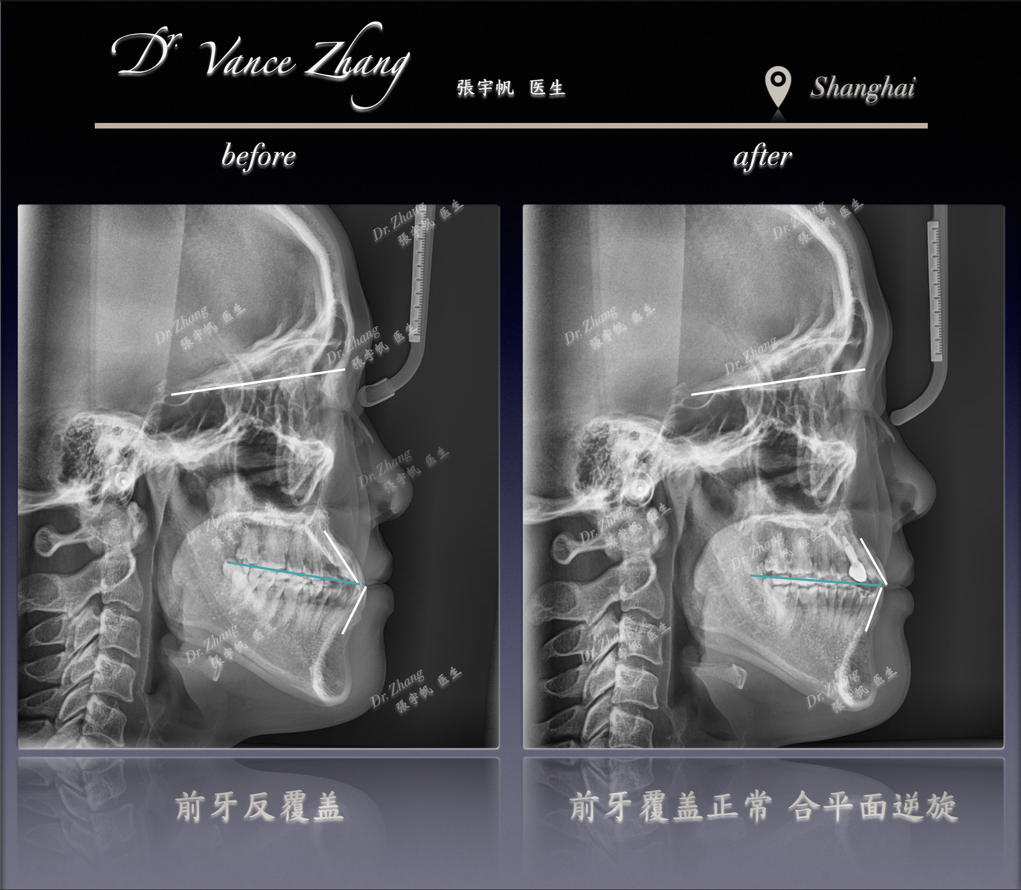 III类反𬌗正畸+种植联合修复正式病例贴图15