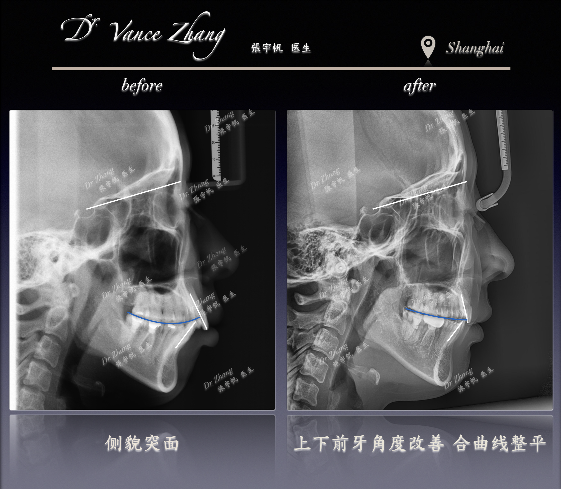 从下颌后缩到协调侧貌正式病例贴图16