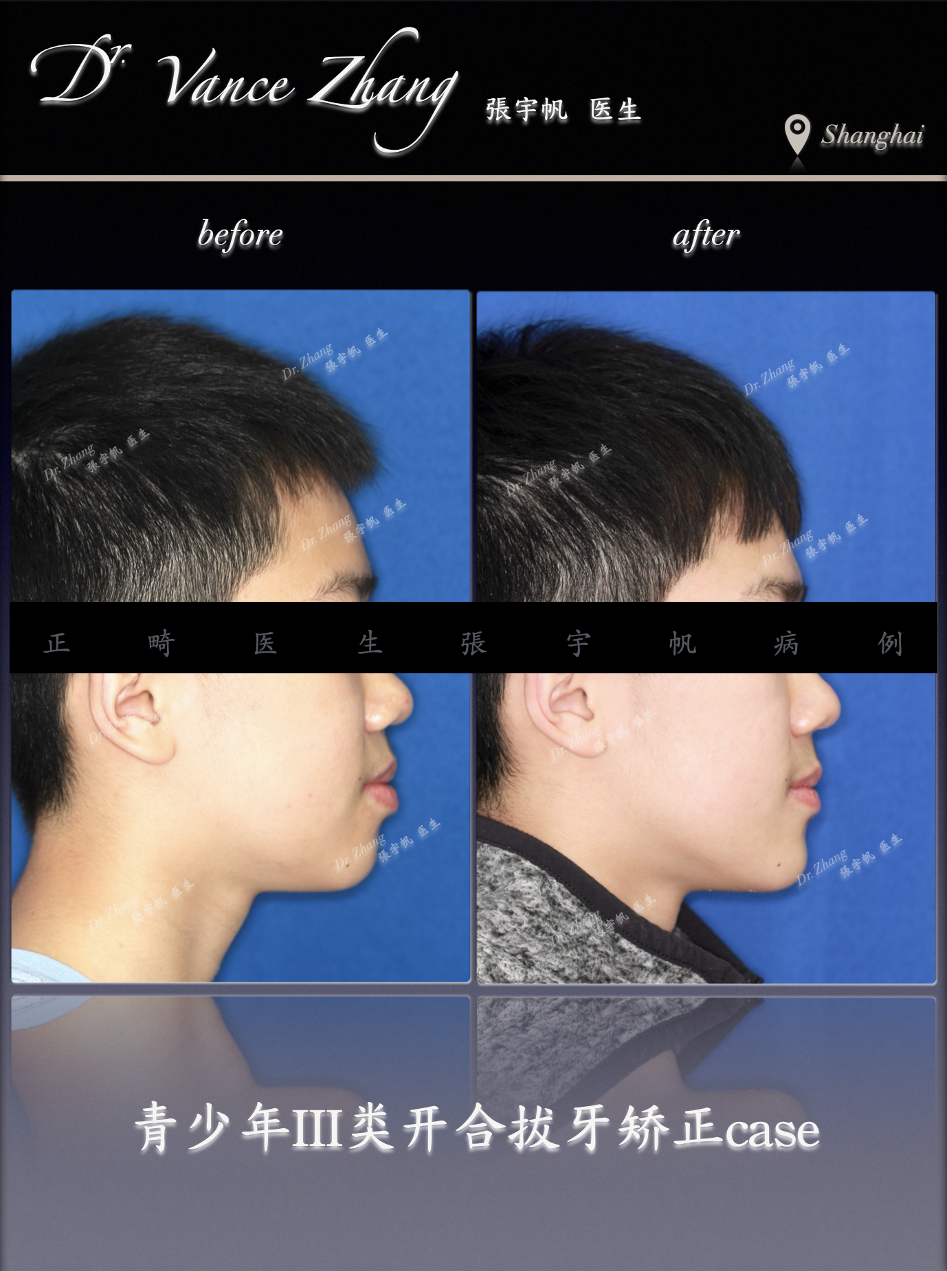 青少年Ⅲ类错𬌗矫治正式病例贴图1