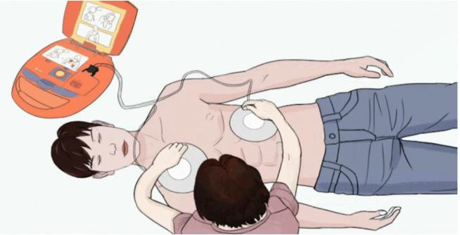 为什么叫除颤仪AED（自动体外除颤仪），大家拿到手都会用的救命神器_https://www.jmylbn.com_新闻资讯_第25张