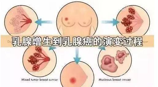 “乳腺增生”怕刮痧，多刮刮就好了！！