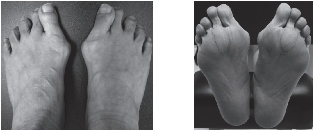 【手术技巧】拇外翻非截骨韧带联合术（Syndesmosis