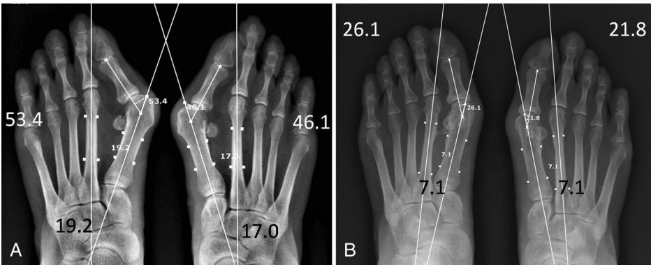 【手术技巧】拇外翻非截骨韧带联合术（Syndesmosis