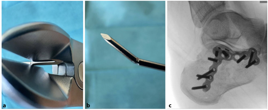 【手术技巧】跟骨骨折的规范操作技术（德国经验）
