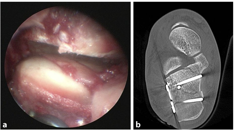 【手术技巧】跟骨骨折的规范操作技术（德国经验）