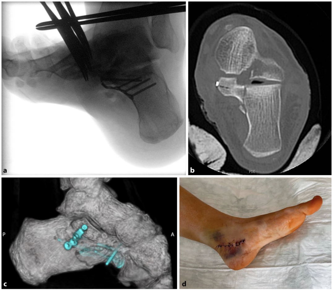 【手术技巧】跟骨骨折的规范操作技术（德国经验）