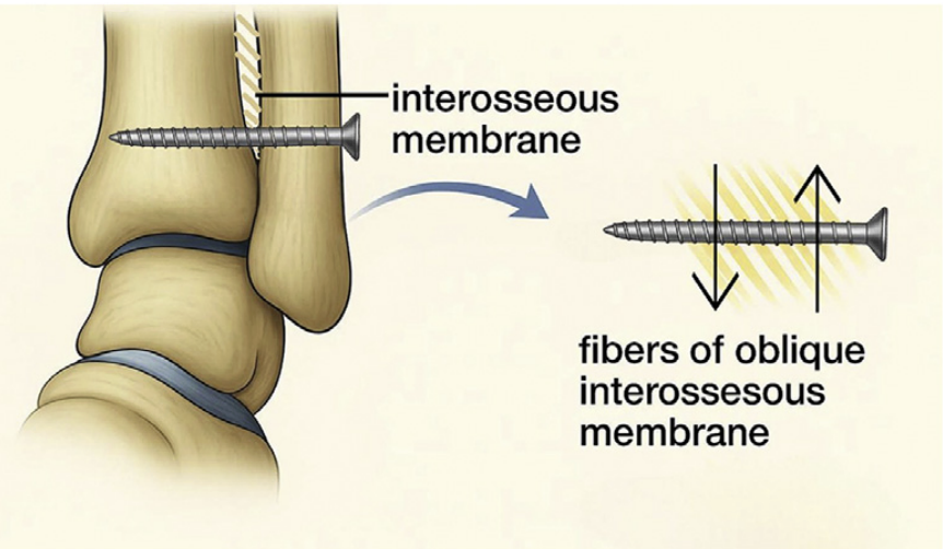 【手术技巧】下胫腓联合螺钉冠状面打歪了要紧不？