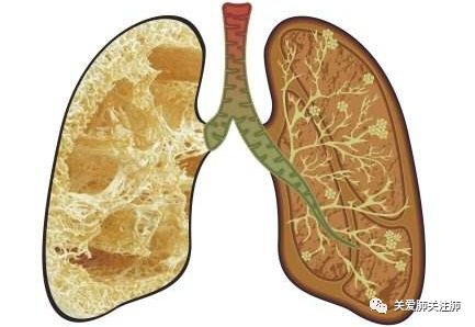 肺纤维化 间质性纤维化 你了解多少 一起肺健康交流 微信公众号文章阅读 Wemp