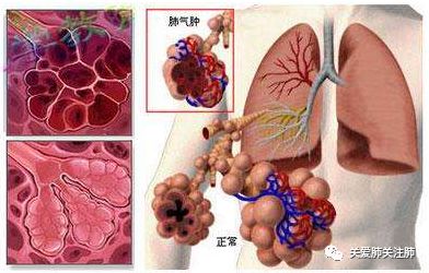 肺气肿治疗秘诀 排痰 排气 肺的呐喊呼吸的痛 微信公众号文章阅读 Wemp