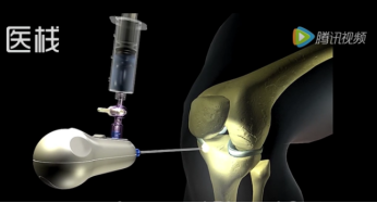 宾得胃镜怎么样深度 ｜ 一次性内窥镜，几百亿的蓝海市场，“谁主沉浮”_https://www.jmylbn.com_新闻资讯_第18张