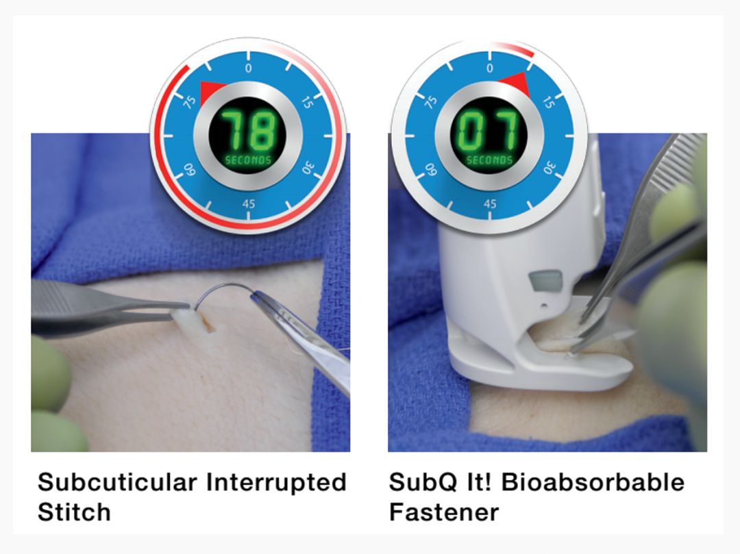 伤口怎么用医用胶速必特(SubQ It!)：手术不留疤的杀手锏 ｜ 美柏访谈_https://www.jmylbn.com_新闻资讯_第7张
