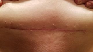 伤口怎么用医用胶速必特(SubQ It!)：手术不留疤的杀手锏 ｜ 美柏访谈_https://www.jmylbn.com_新闻资讯_第4张