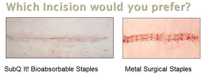 伤口怎么用医用胶速必特(SubQ It!)：手术不留疤的杀手锏 ｜ 美柏访谈_https://www.jmylbn.com_新闻资讯_第6张