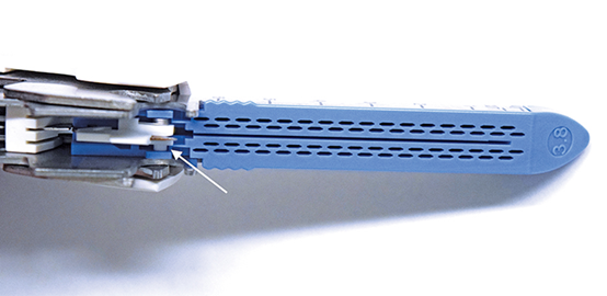 肠道吻合器是什么材质超级干货 ｜ 专家指导：胃肠吻合术使用线型吻合器的六大步骤_https://www.jmylbn.com_新闻资讯_第4张