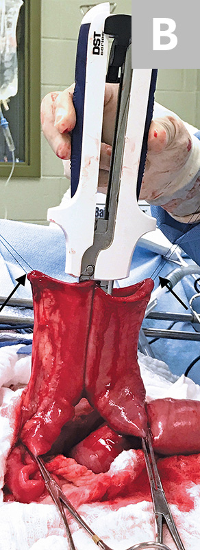 肠道吻合器是什么材质超级干货 ｜ 专家指导：胃肠吻合术使用线型吻合器的六大步骤_https://www.jmylbn.com_新闻资讯_第8张