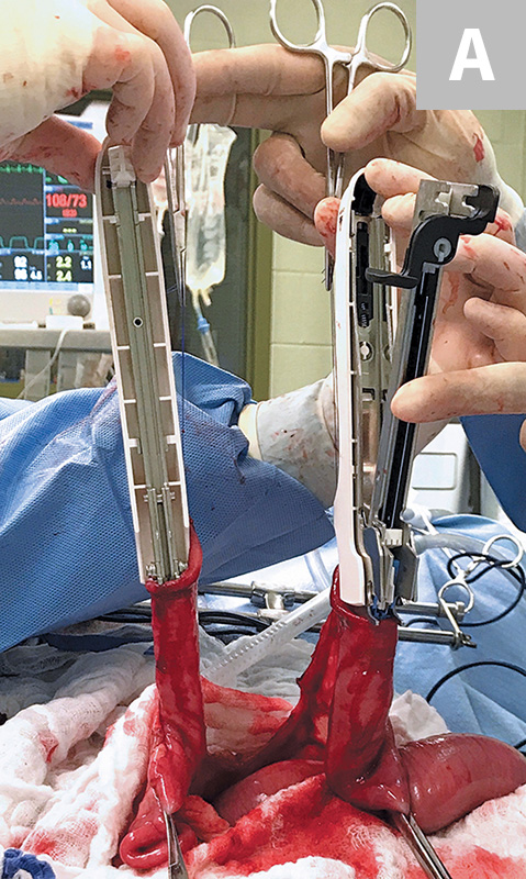 肠道吻合器是什么材质超级干货 ｜ 专家指导：胃肠吻合术使用线型吻合器的六大步骤_https://www.jmylbn.com_新闻资讯_第7张