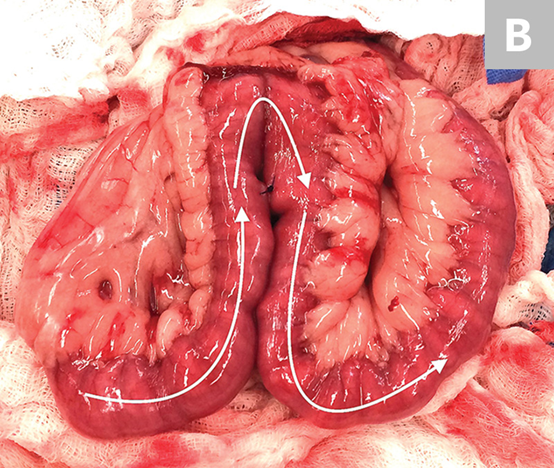 肠道吻合器是什么材质超级干货 ｜ 专家指导：胃肠吻合术使用线型吻合器的六大步骤_https://www.jmylbn.com_新闻资讯_第11张