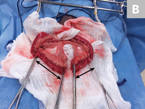 肠道吻合器是什么材质超级干货 ｜ 专家指导：胃肠吻合术使用线型吻合器的六大步骤_https://www.jmylbn.com_新闻资讯_第6张