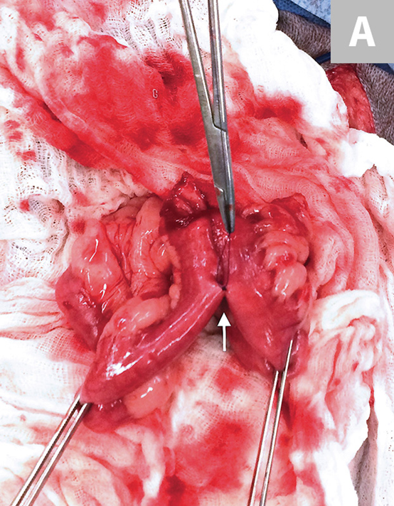 肠道吻合器是什么材质超级干货 ｜ 专家指导：胃肠吻合术使用线型吻合器的六大步骤_https://www.jmylbn.com_新闻资讯_第10张