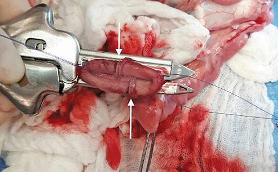 肠道吻合器是什么材质超级干货 ｜ 专家指导：胃肠吻合术使用线型吻合器的六大步骤_https://www.jmylbn.com_新闻资讯_第9张