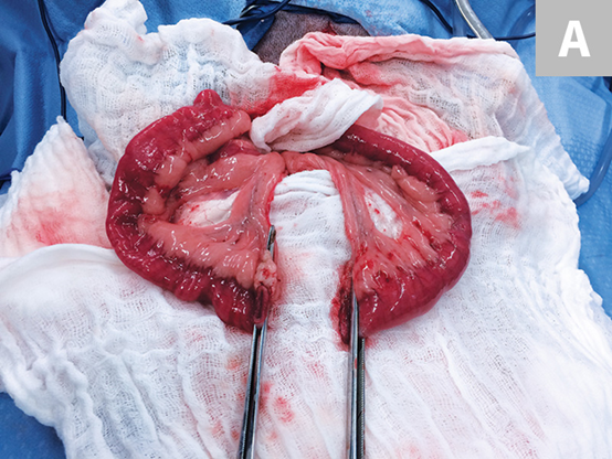 肠道吻合器是什么材质超级干货 ｜ 专家指导：胃肠吻合术使用线型吻合器的六大步骤_https://www.jmylbn.com_新闻资讯_第5张