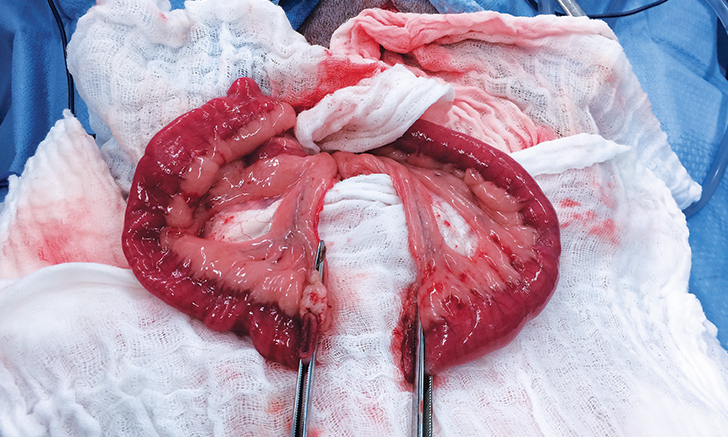 肠道吻合器是什么材质超级干货 ｜ 专家指导：胃肠吻合术使用线型吻合器的六大步骤_https://www.jmylbn.com_新闻资讯_第2张