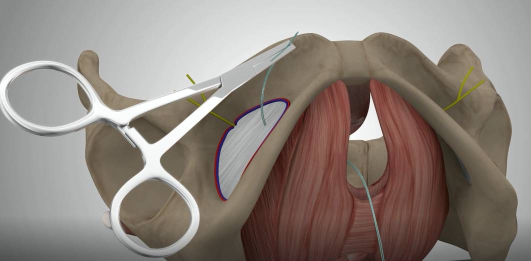 tvt-o手术_尿失禁_手术_治疗方式 - 好大夫在线