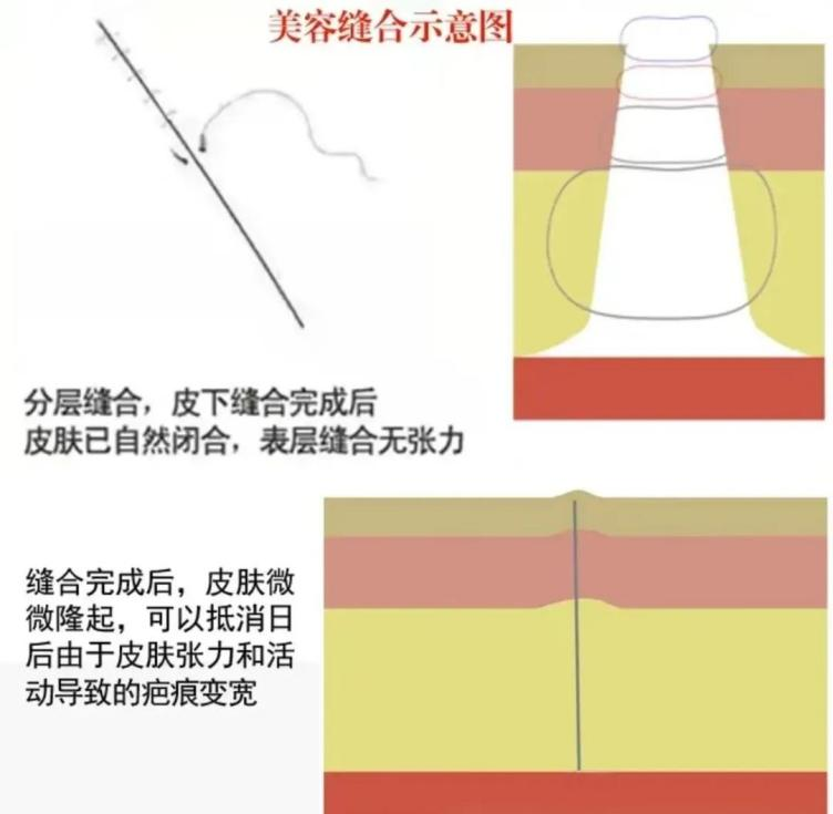 缝合皮肤用什么针皮肤受外伤了，要缝“美容线”？要用“美容针”？_https://www.jmylbn.com_新闻资讯_第1张