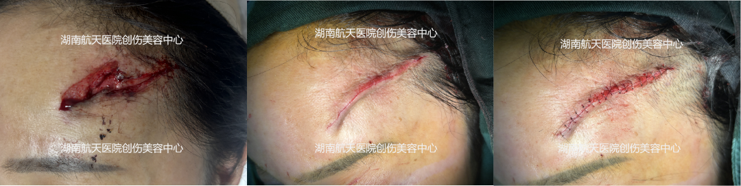 缝合皮肤用什么针皮肤受外伤了，要缝“美容线”？要用“美容针”？_https://www.jmylbn.com_新闻资讯_第4张