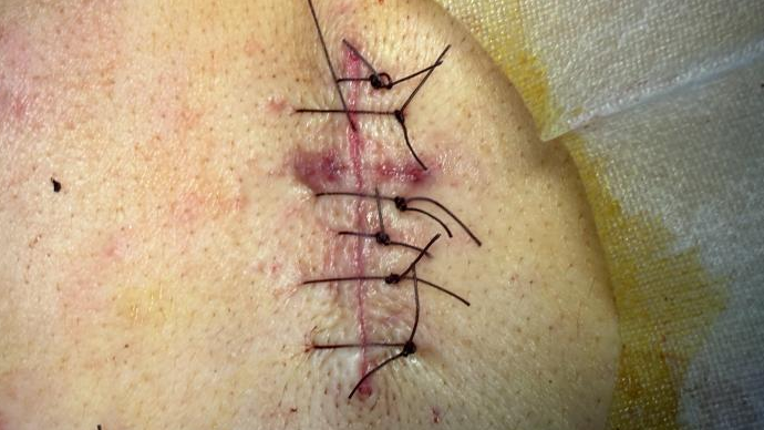 缝合皮肤用什么针皮肤受外伤了，要缝“美容线”？要用“美容针”？_https://www.jmylbn.com_新闻资讯_第3张