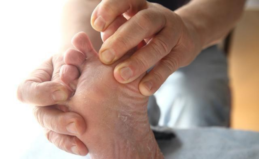 【医说就懂】手脚脱皮，我是不是得了癣啊？