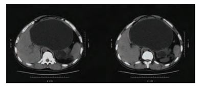 波科支架怎么样五分钟解决胰腺假性囊肿，波科AXIOS支架和电灼增强输送系统 ｜ 盖伦奖提名医械详解Ⅹ_https://www.jmylbn.com_新闻资讯_第5张