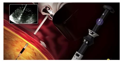 波科支架怎么样五分钟解决胰腺假性囊肿，波科AXIOS支架和电灼增强输送系统 ｜ 盖伦奖提名医械详解Ⅹ_https://www.jmylbn.com_新闻资讯_第13张