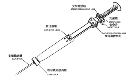 波科支架怎么样五分钟解决胰腺假性囊肿，波科AXIOS支架和电灼增强输送系统 ｜ 盖伦奖提名医械详解Ⅹ_https://www.jmylbn.com_新闻资讯_第15张