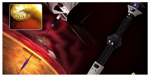 波科支架怎么样五分钟解决胰腺假性囊肿，波科AXIOS支架和电灼增强输送系统 ｜ 盖伦奖提名医械详解Ⅹ_https://www.jmylbn.com_新闻资讯_第14张