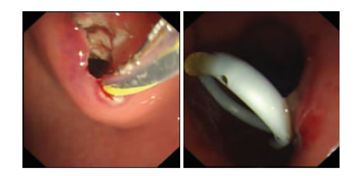 波科支架怎么样五分钟解决胰腺假性囊肿，波科AXIOS支架和电灼增强输送系统 ｜ 盖伦奖提名医械详解Ⅹ_https://www.jmylbn.com_新闻资讯_第6张